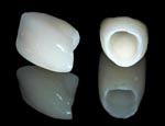 ceramic crowns