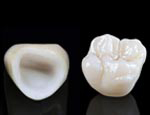 150-zirconia-crown