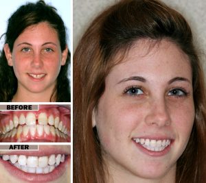Adult Orthodontics in Brooklyn, NY