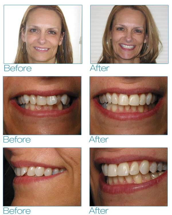 six month smiles before after debra