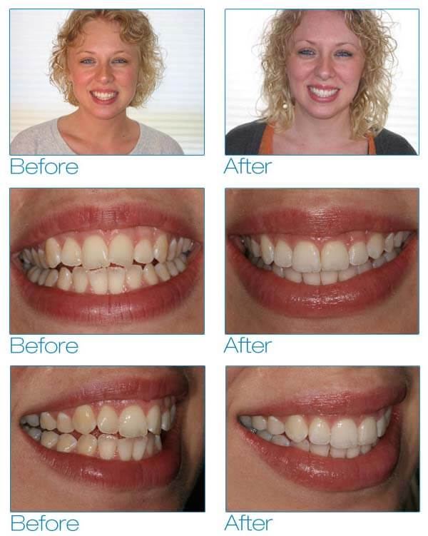 six month smiles before after