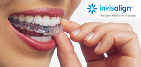 Invisalign