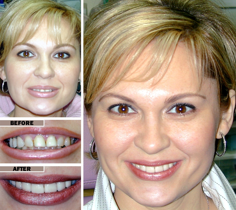 Best Quality Dental Veneers in Brooklyn NY