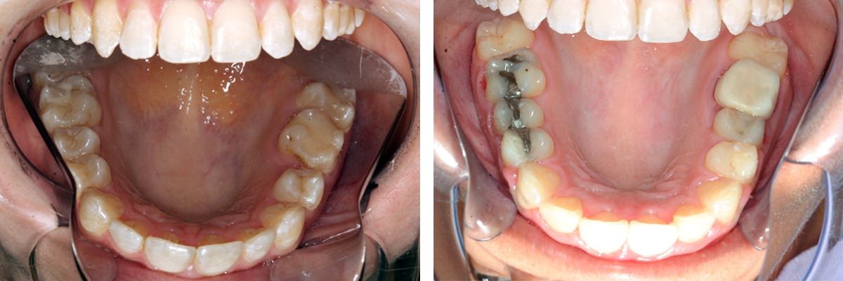 Composite Dental Fillings