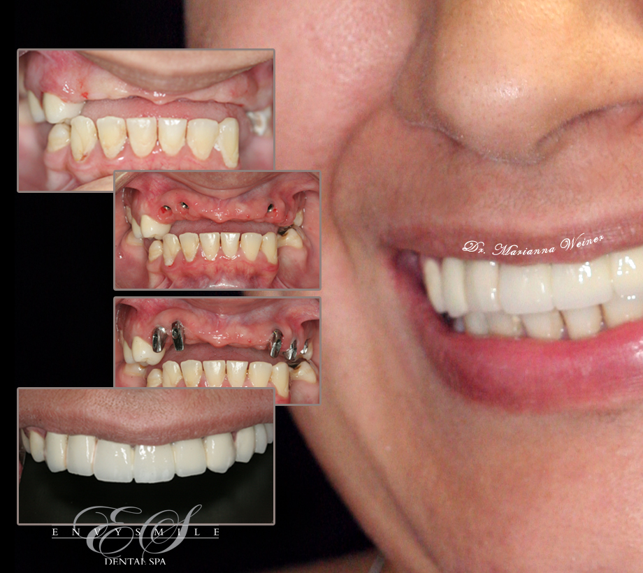 Three steps of implants