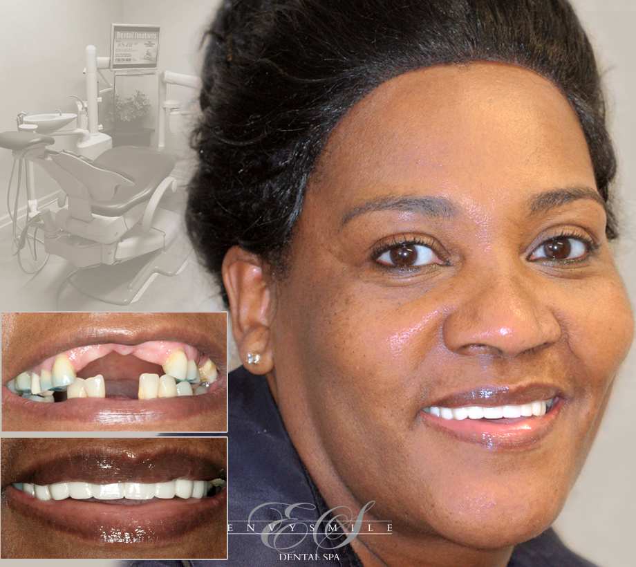 Dental Implants Brooklyn Affordable Teeth Implants Implant Dentist