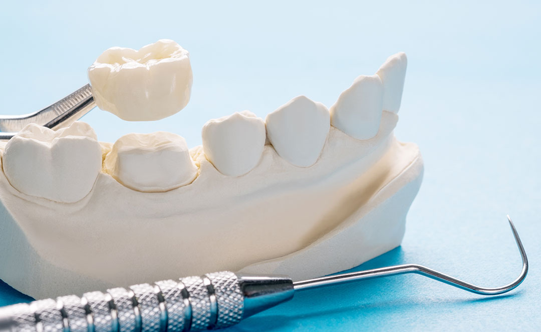 Dental Crown Procedure in Brooklyn, NY Ceramic Crowns