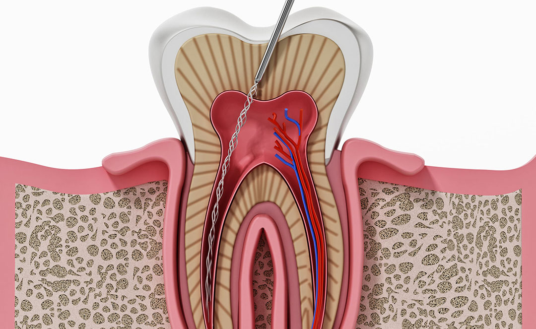 Root Canal Procedure (Cost, Pain & Retreatment) Dentist in Brooklyn