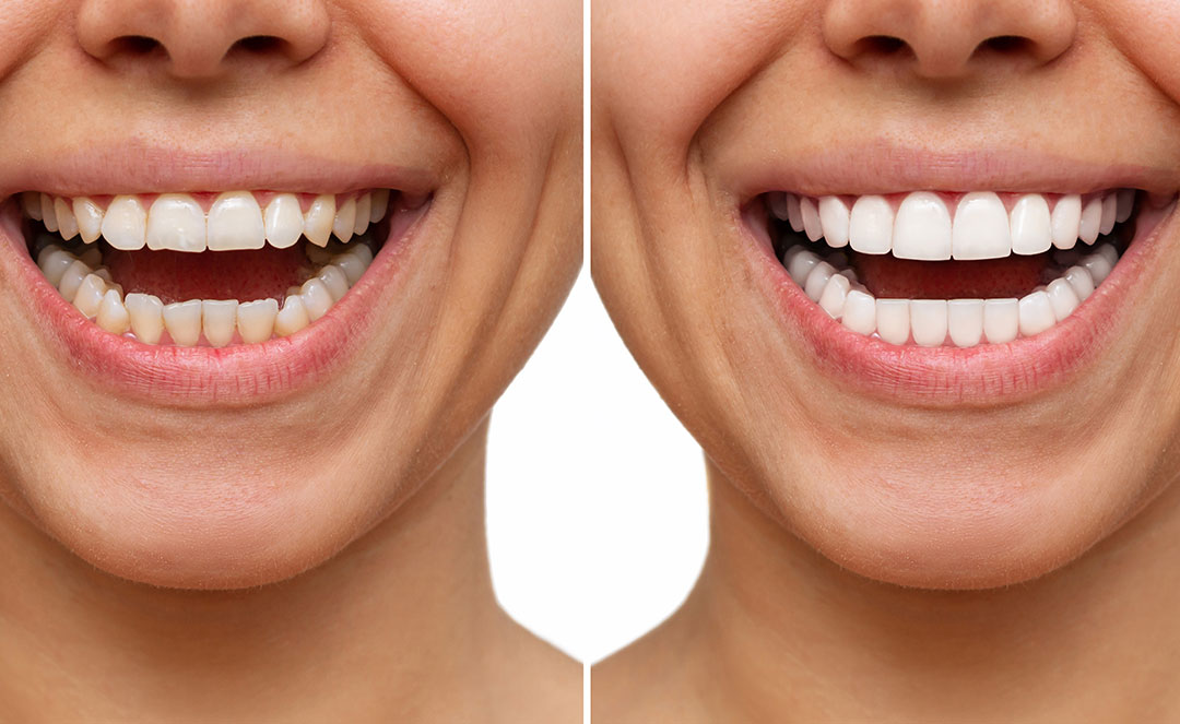 https://www.envysmile.com/wp-content/uploads/2023/08/Teeth-Reshape.jpg?utm_source=chatgpt.com