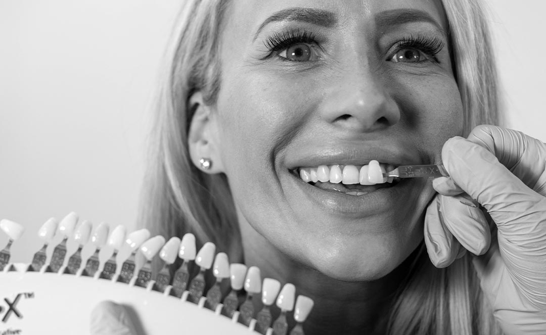 Dental Veneers Brooklyn Porcelain Veneers Teeth, Press on Veneers