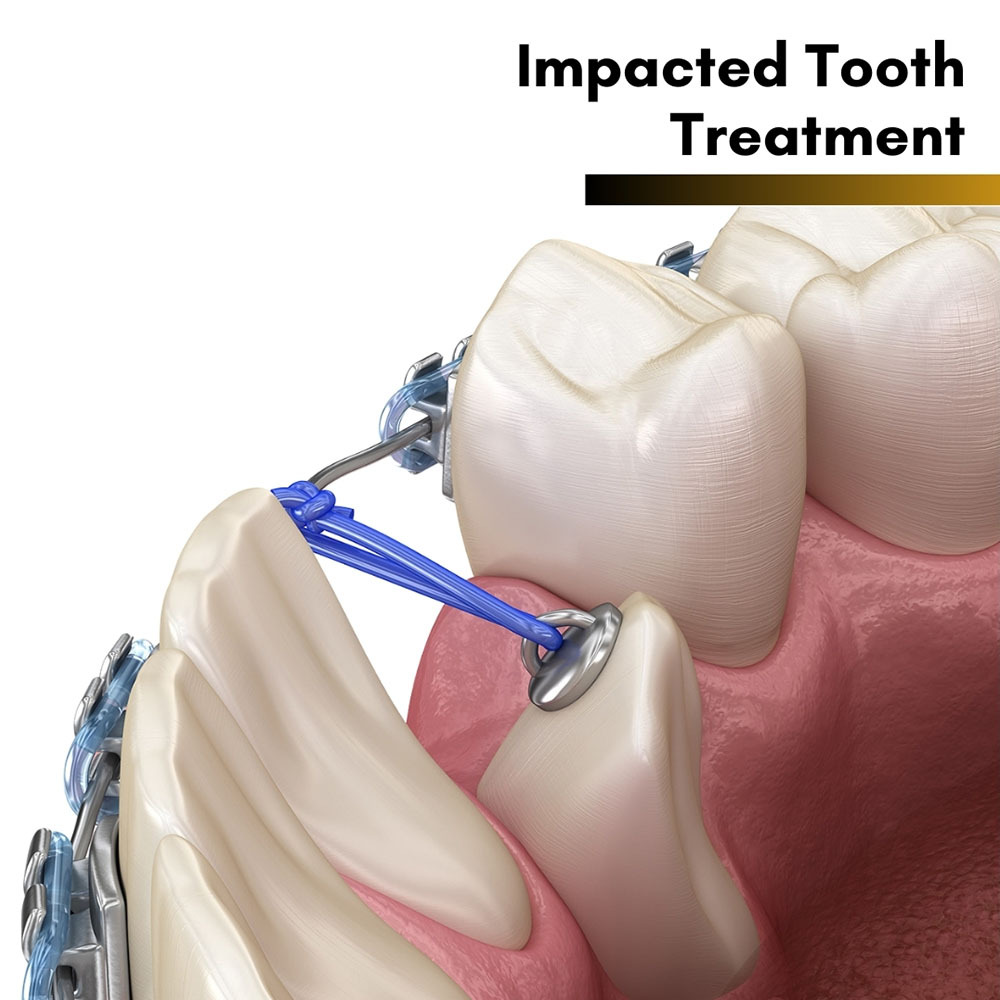 Impacted Tooth Treatment in Brooklyn