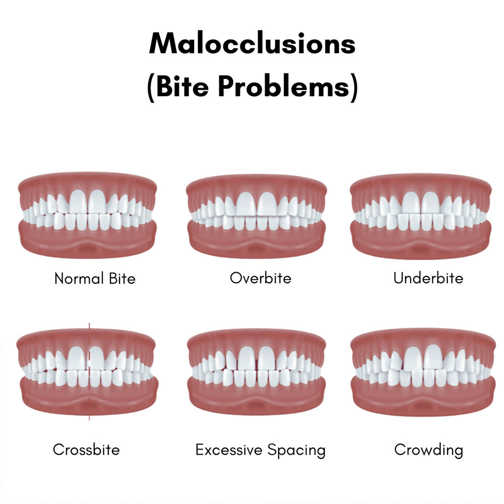 Malocclusions Treatment in Brooklyn