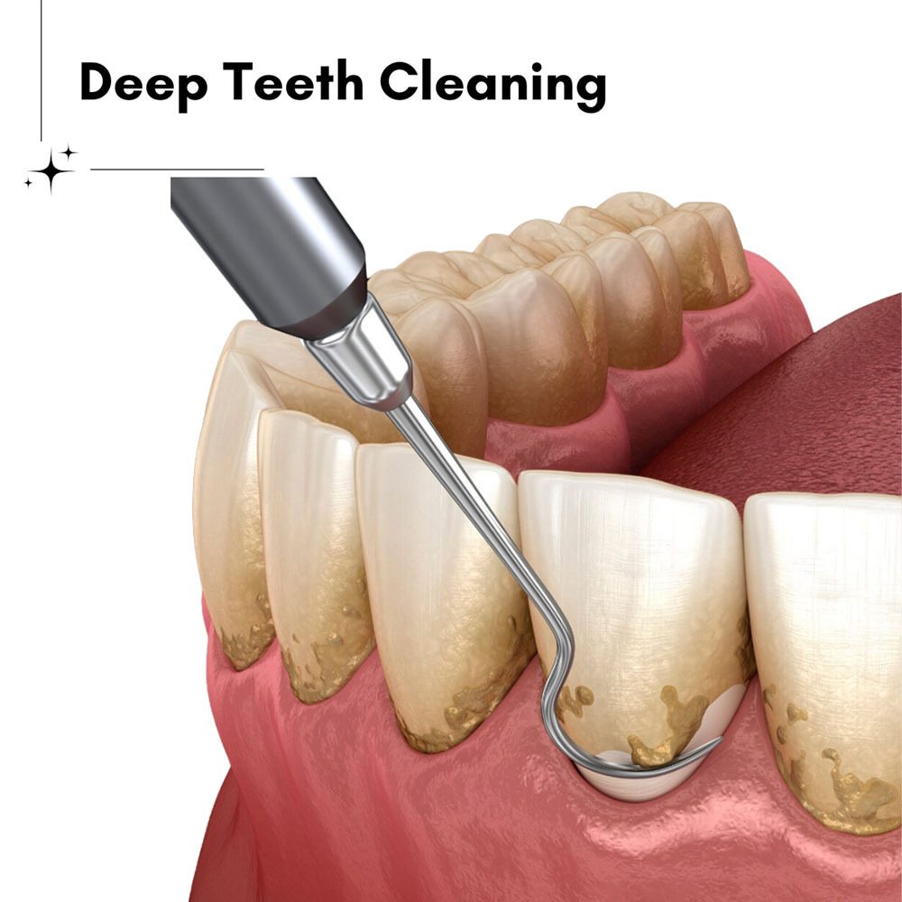 Deep Teeth Cleaning Brooklyn
