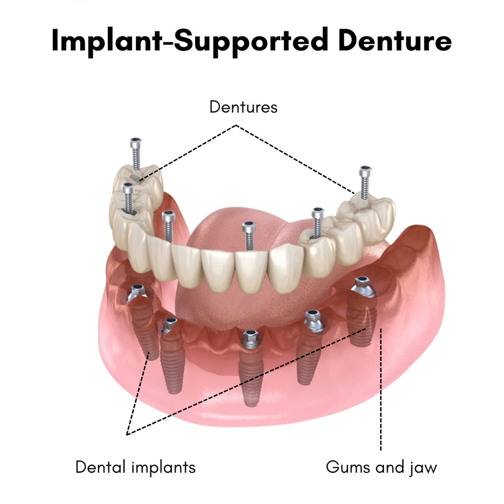 Implant Supported Denture in Brooklyn NY