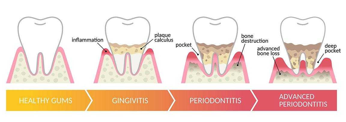 Periodontal Disease Treatment Brooklyn