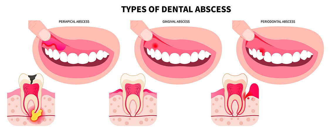Types of Dental Abscess