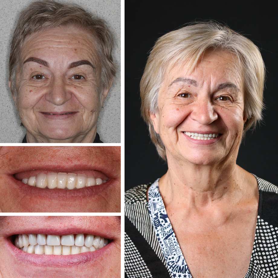 Affordable Dentures Brooklyn Before After Case (Svetlana Bezuglova)