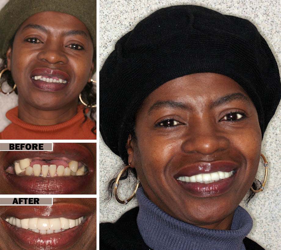Affordable Dentures Brooklyn Before After